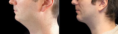 Chin Augmentation Before & After Gallery - Patient 240330 - Image 1