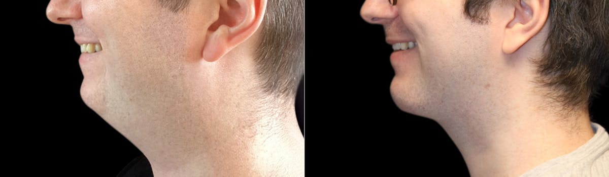 Chin Augmentation Before & After Gallery - Patient 240330 - Image 2