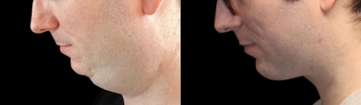 Chin Augmentation Before & After Gallery - Patient 240330 - Image 3