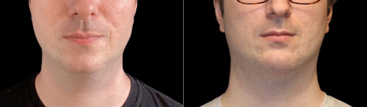 Chin Augmentation Before & After Gallery - Patient 240330 - Image 4
