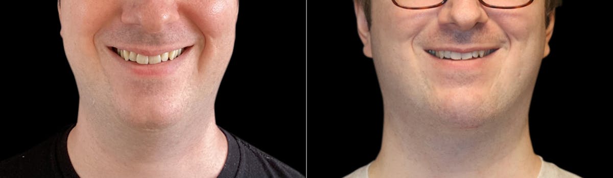 Chin Augmentation Before & After Gallery - Patient 240330 - Image 5