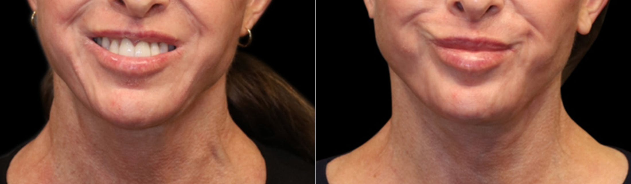 Deep Plane Facelift Before & After Gallery - Patient 396546 - Image 4