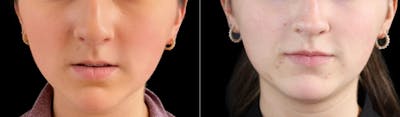 Lip Augmentation Before & After Gallery - Patient 385367 - Image 1