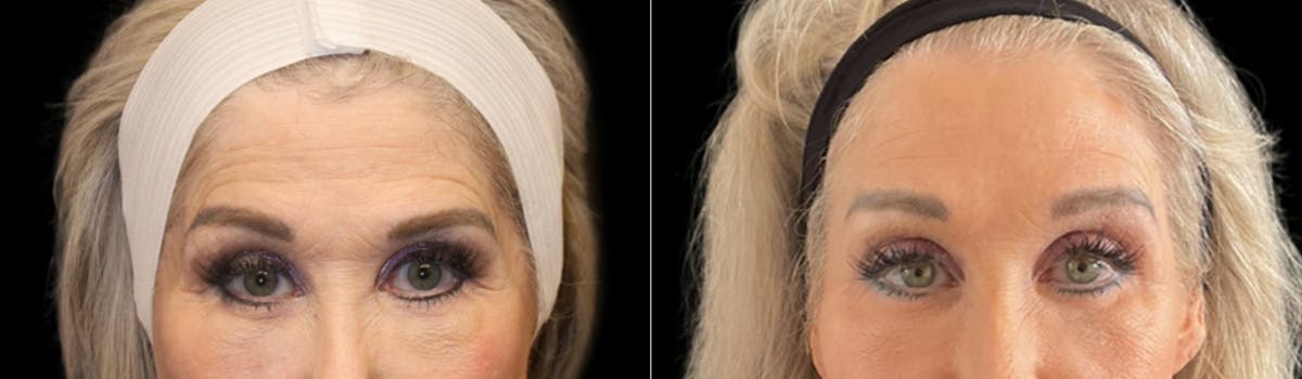 Brow Lift Before & After Gallery - Patient 236713 - Image 1