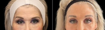 Brow Lift Before & After Gallery - Patient 236713 - Image 1