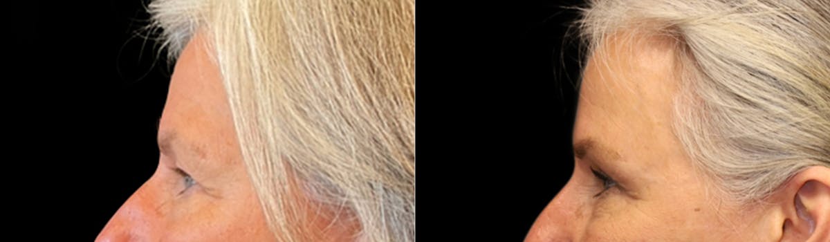 Blepharoplasty Before & After Gallery - Patient 252068 - Image 6