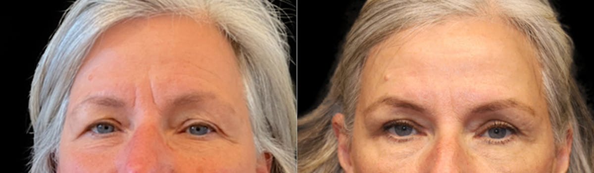 Blepharoplasty Before & After Gallery - Patient 252068 - Image 2