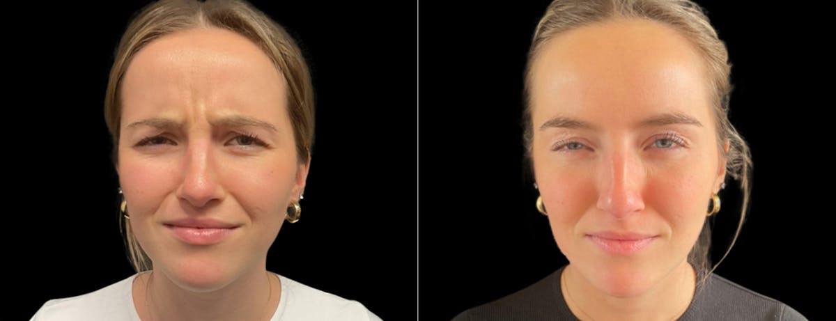 Botox Before & After Gallery - Patient 271724 - Image 4