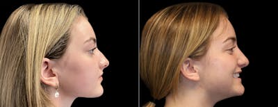 Rhinoplasty Before & After Gallery - Patient 283375 - Image 1