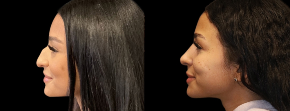 Ultrasonic Piezo Rhinoplasty