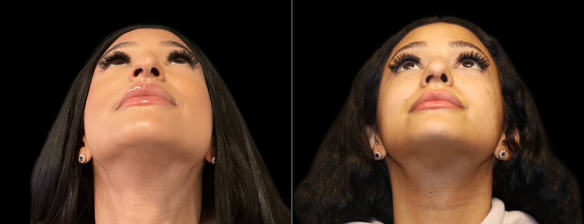 Rhinoplasty Before & After Gallery - Patient 337396 - Image 4