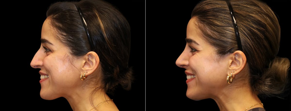 Rhinoplasty Before & After Gallery - Patient 149753 - Image 6