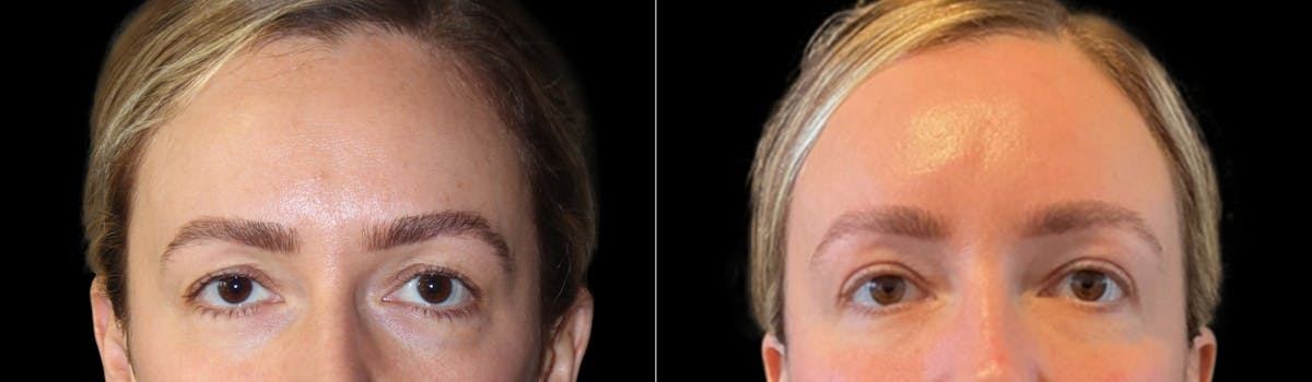 Blepharoplasty Before & After Gallery - Patient 424091 - Image 1