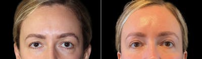 Blepharoplasty Before & After Gallery - Patient 424091 - Image 1