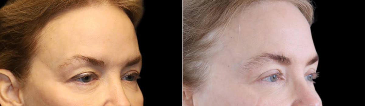 Blepharoplasty Before & After Gallery - Patient 424091 - Image 6