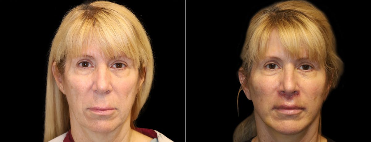 Facelift Before & After Gallery - Patient 284827 - Image 4