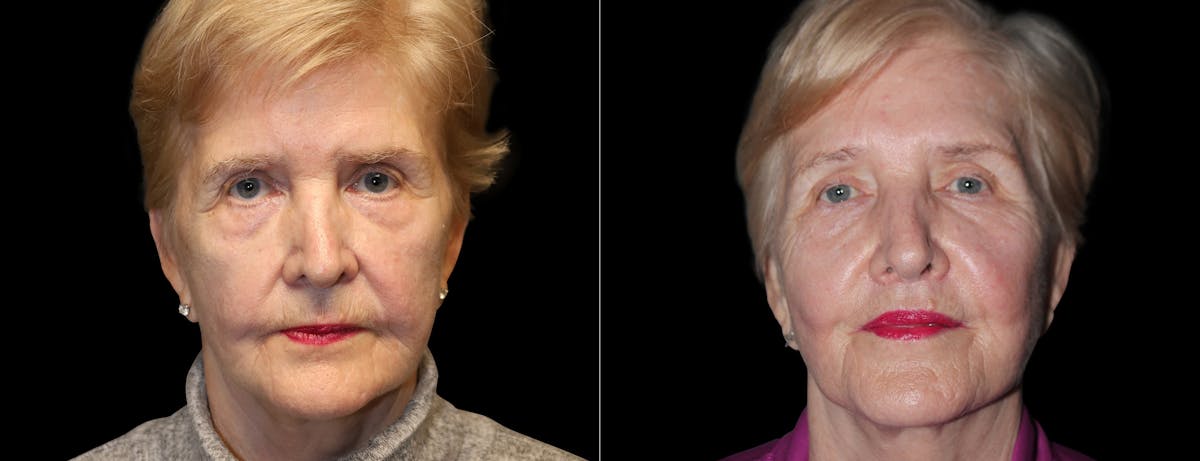Lip Lift Before & After Gallery - Patient 972339 - Image 1