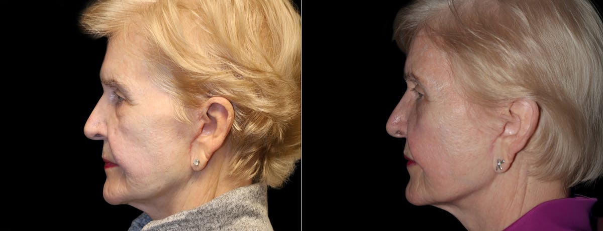 Lip Lift Before & After Gallery - Patient 972339 - Image 4