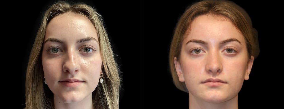 Rhinoplasty Before & After Gallery - Patient 283375 - Image 3