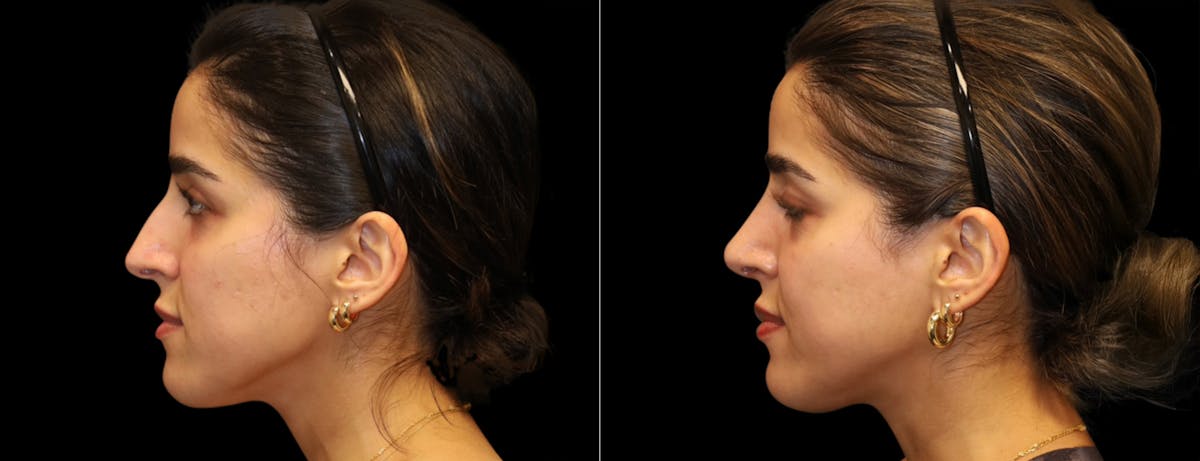 Rhinoplasty Before & After Gallery - Patient 149753 - Image 5