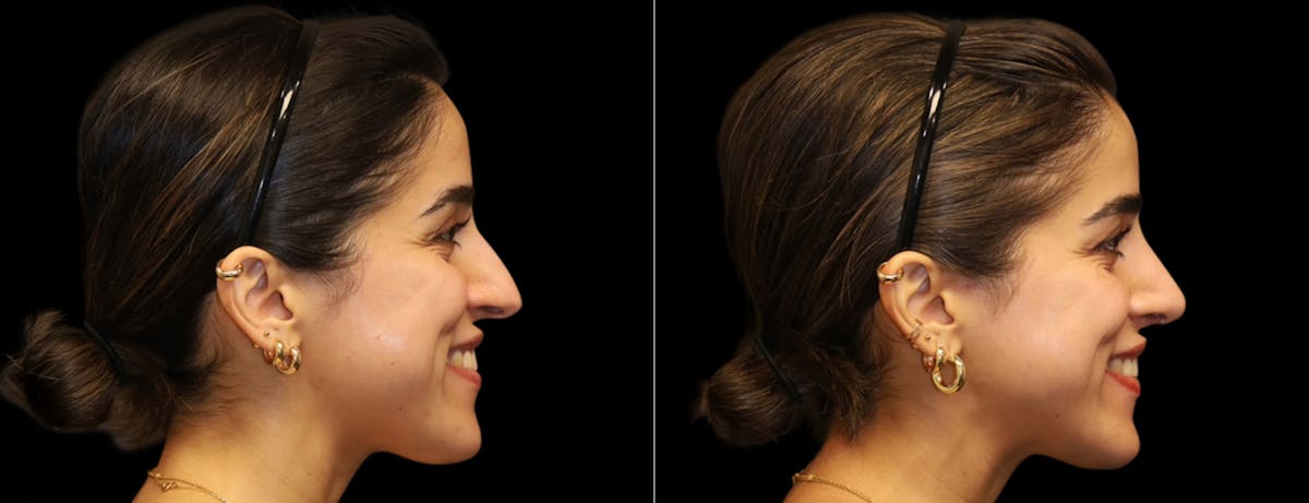 Rhinoplasty Before & After Gallery - Patient 149753 - Image 2