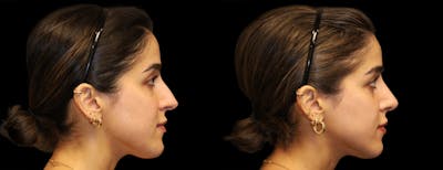 Rhinoplasty Before & After Gallery - Patient 149753 - Image 1