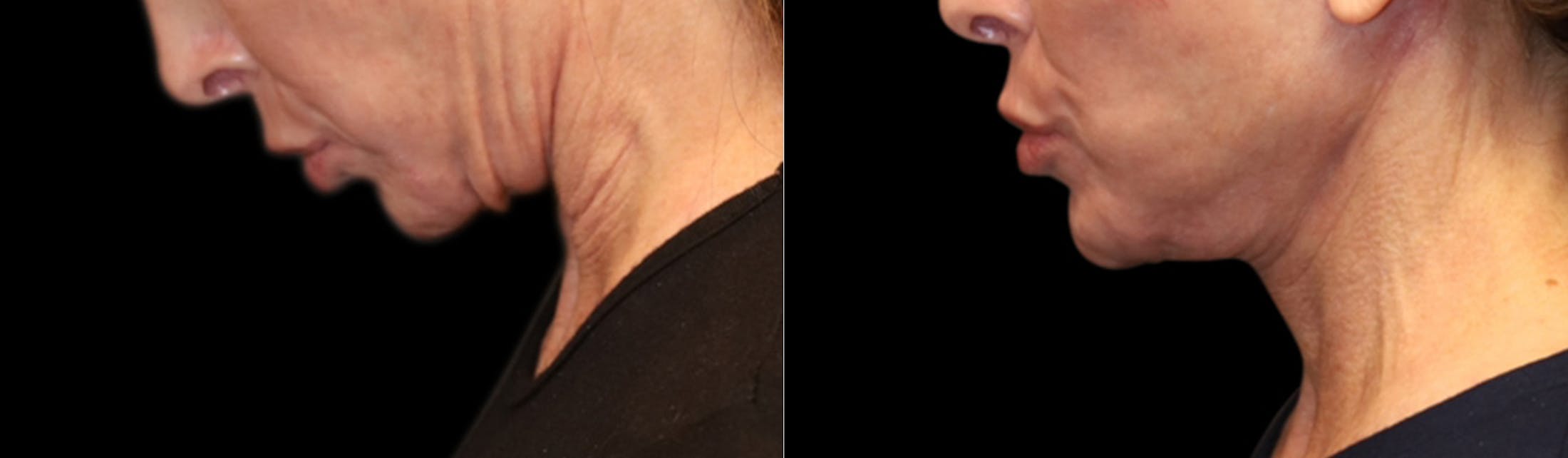 Deep Plane Facelift Before & After Gallery - Patient 396546 - Image 7