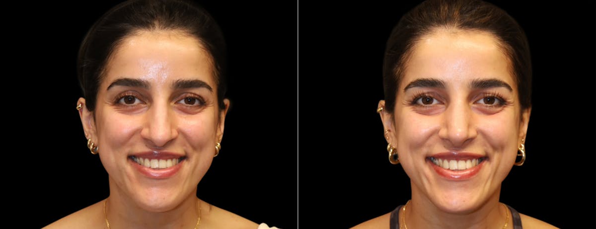 Rhinoplasty Before & After Gallery - Patient 149753 - Image 3