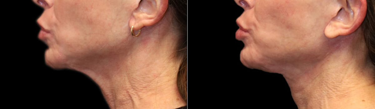 Deep Plane Facelift Before & After Gallery - Patient 396546 - Image 1