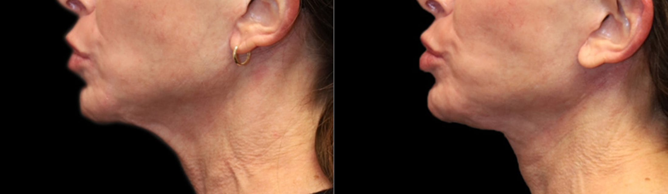 Deep Plane Facelift Before & After Gallery - Patient 396546 - Image 5