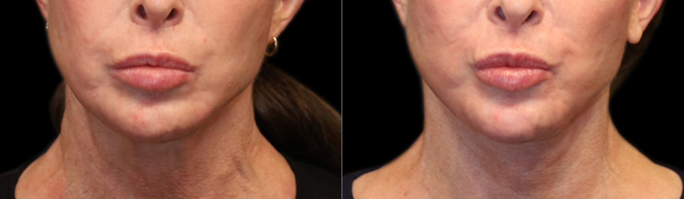Deep Plane Facelift Before & After Gallery - Patient 396546 - Image 2