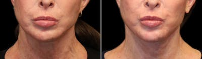 Deep Plane Facelift Before & After Gallery - Patient 396546 - Image 1