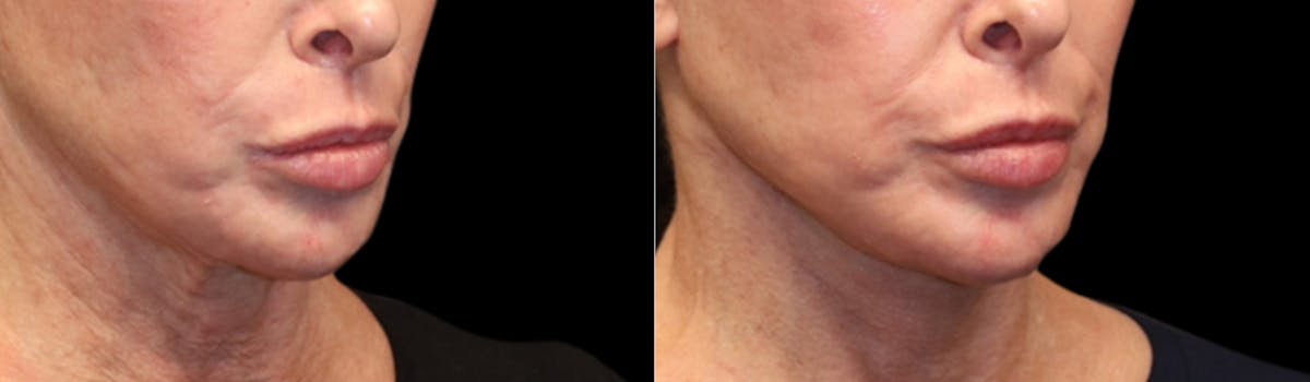 Deep Plane Facelift Before & After Gallery - Patient 396546 - Image 6