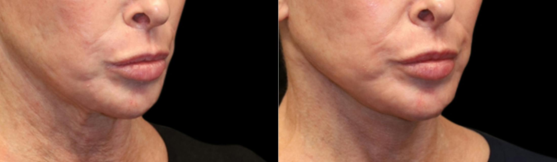 Deep Plane Facelift Before & After Gallery - Patient 396546 - Image 1