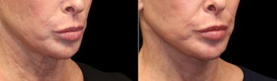 Deep Plane Facelift Before & After Gallery - Patient 396546 - Image 1