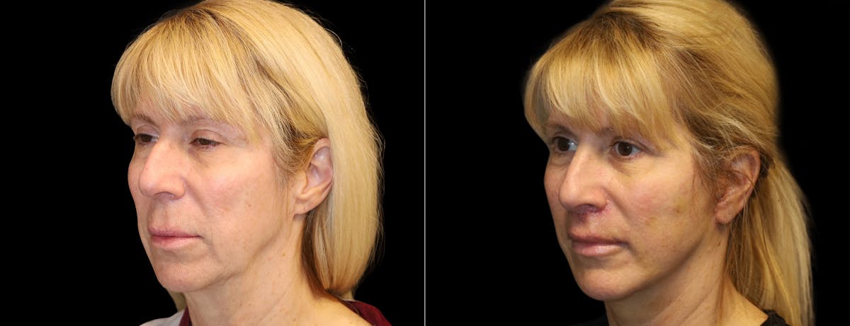 Facelift Before & After Gallery - Patient 284827 - Image 3