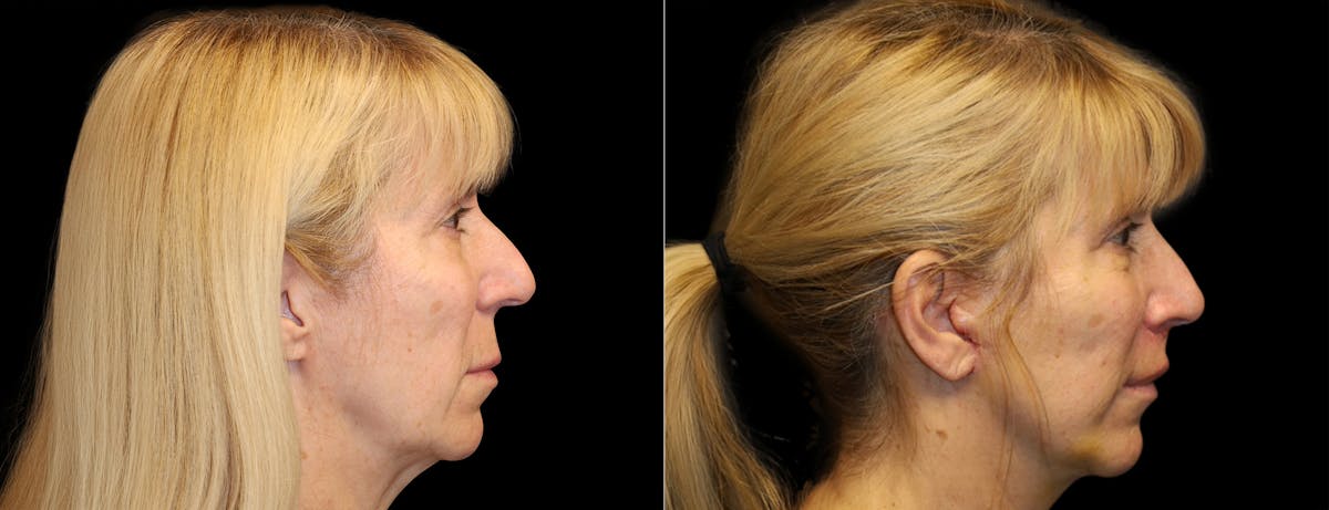 Facelift Before & After Gallery - Patient 284827 - Image 2