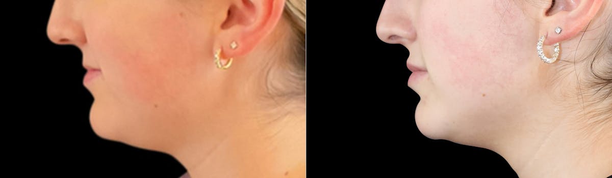 Lip Augmentation Before & After Gallery - Patient 385367 - Image 3