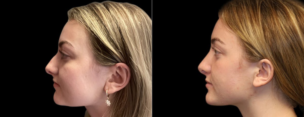 Rhinoplasty Before & After Gallery - Patient 283375 - Image 6