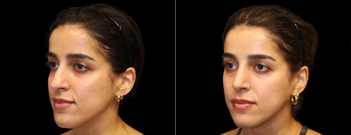 Rhinoplasty Before & After Gallery - Patient 149753 - Image 4