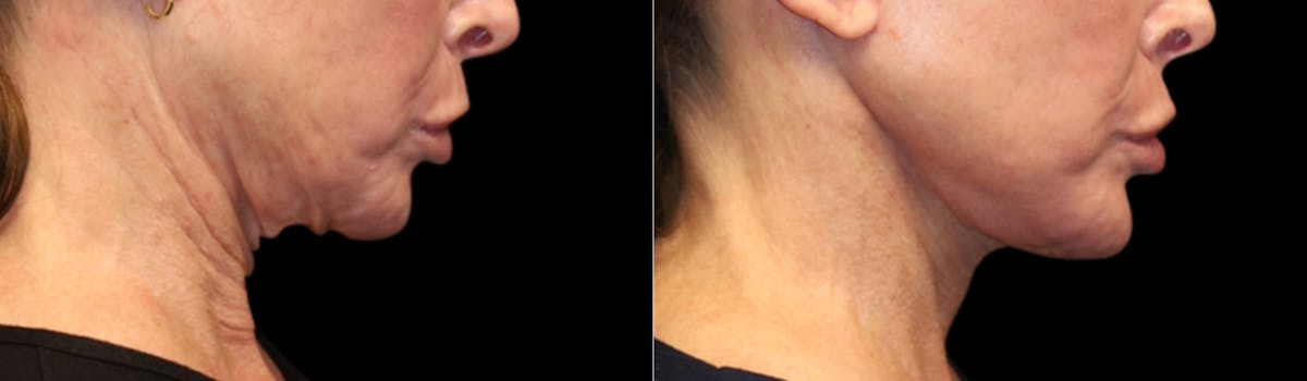 Deep Plane Facelift Before & After Gallery - Patient 396546 - Image 8