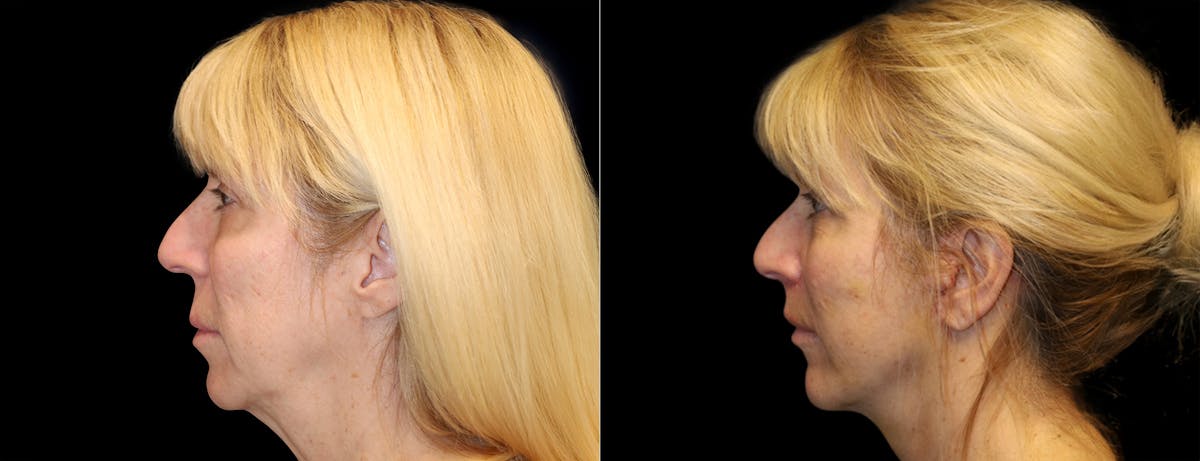 Facelift Before & After Gallery - Patient 284827 - Image 1
