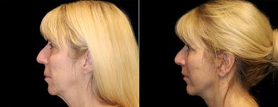 Facelift Before & After Gallery - Patient 284827 - Image 1