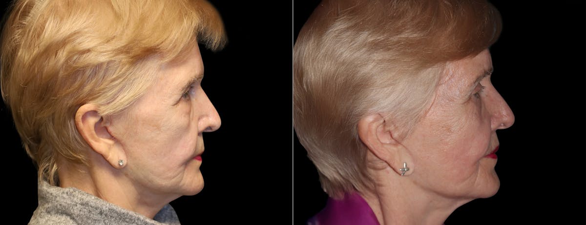 Lip Lift Before & After Gallery - Patient 972339 - Image 3
