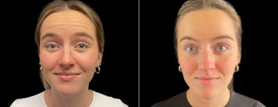 Botox Before & After Gallery - Patient 271724 - Image 1