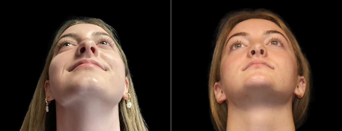 Rhinoplasty Before & After Gallery - Patient 283375 - Image 4