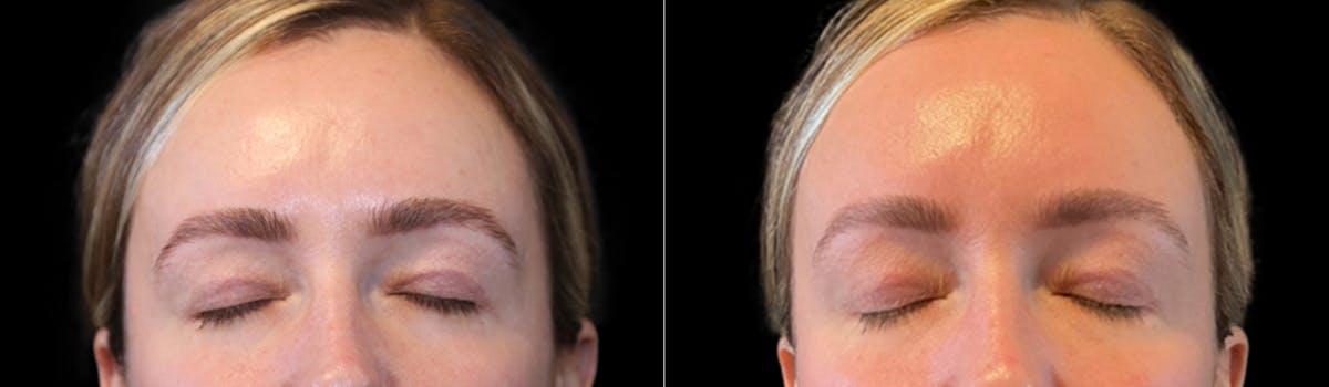 Blepharoplasty Before & After Gallery - Patient 424091 - Image 3