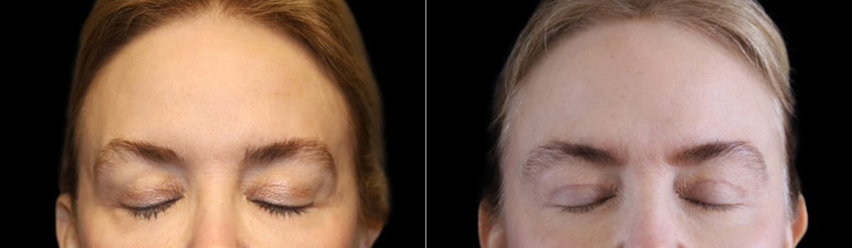 Blepharoplasty Before & After Gallery - Patient 424091 - Image 4