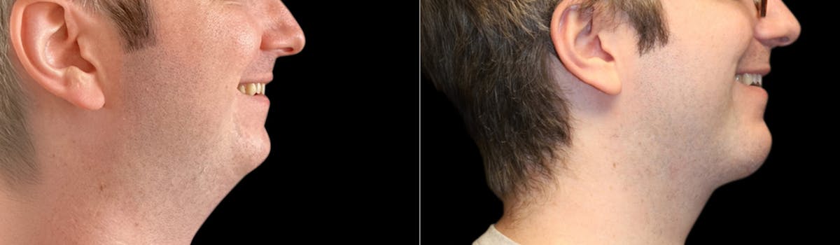 Chin Augmentation Before & After Gallery - Patient 240330 - Image 8