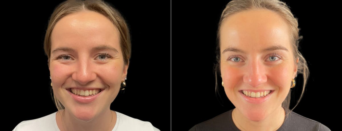 Botox Before & After Gallery - Patient 271724 - Image 2